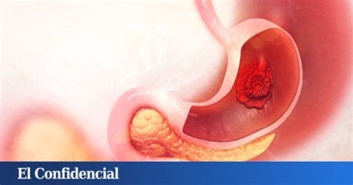 Estos son los síntomas que te avisan del cáncer de estómago: hazles caso