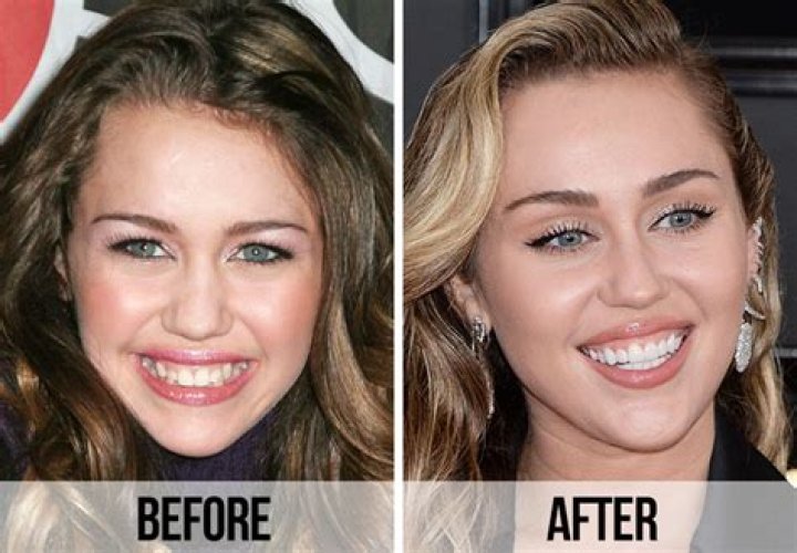 Jasmine Secrest’s New Teeth; Before and After Pictures!