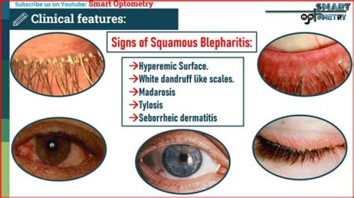 Switchword Chronic Blepharitis [Eyelid] Meaning
